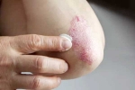 Skin disorders health problems, Skin disorders symptoms, five common skin disorders and their symptoms, Immune system