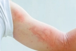 symptoms, symptoms, dermatological symptoms could be a sign for covid 19 infection, Dermatologist