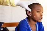 Monkeypox Outbreak cases in India, Monkeypox, is monkeypox outbreak coming to india, Monkeypox