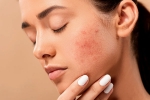 skin, skin care products, 10 ways to get rid of pimples at home, Healthy food